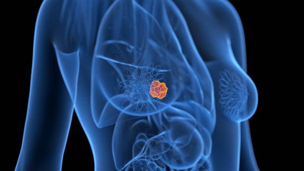 capivasertib-breast-cancer-survival-breakthrough-velsmedia.