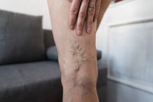 natural-remedy-blood-clots-tamil-vels-media